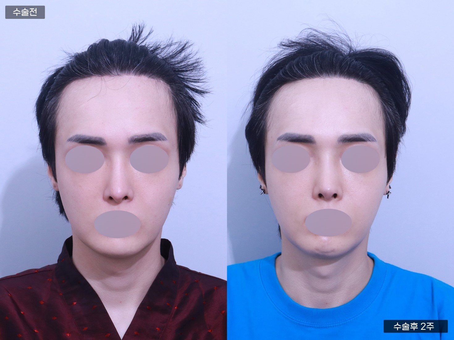 코재수술 +콧대교정