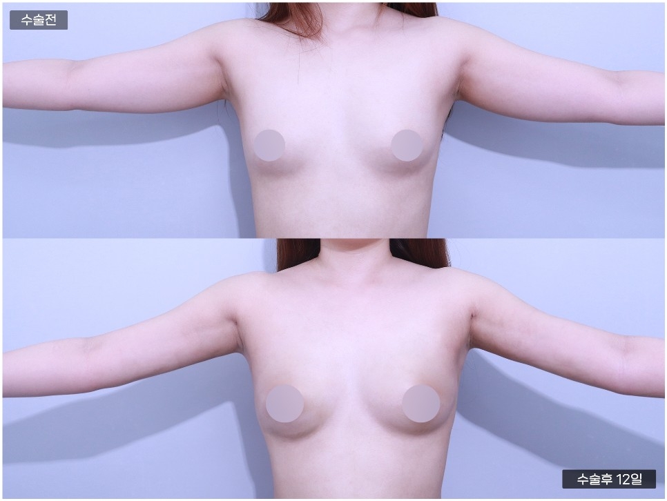 바디 지방흡입 [ 팔 ]