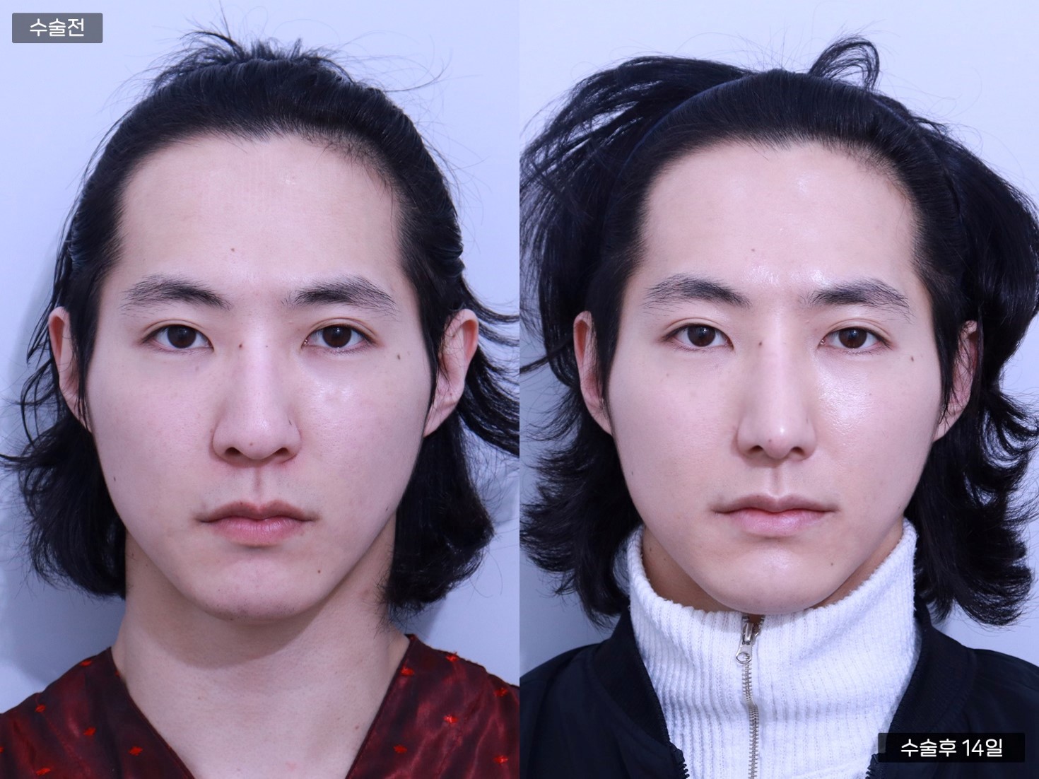 남자코 + 콧대 + 복코교정