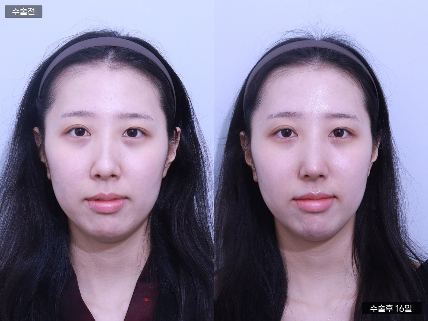 콧대교정 + 매부리교정