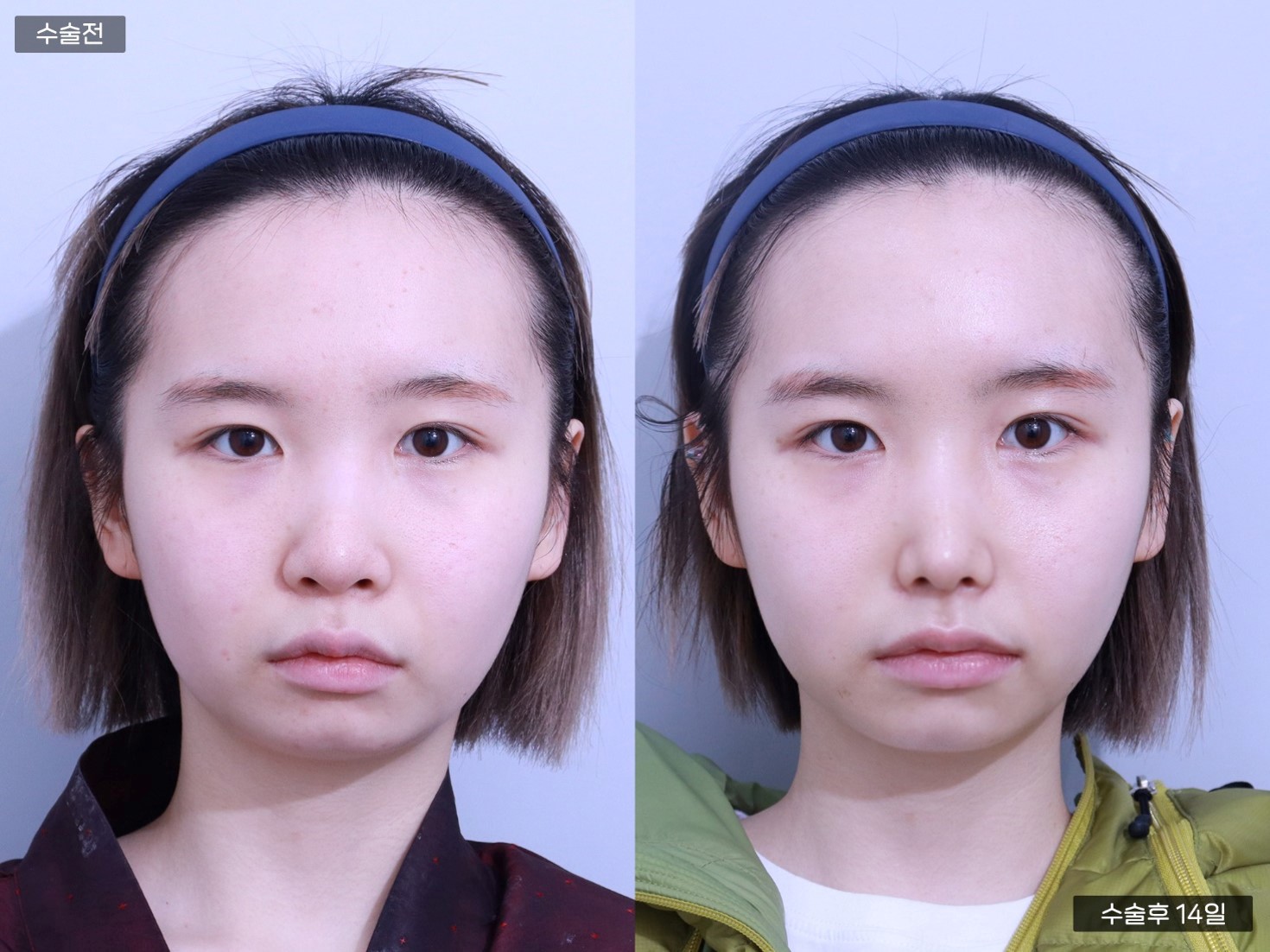 코끝교정 + 복코고정 + 콧대 + 매부리코