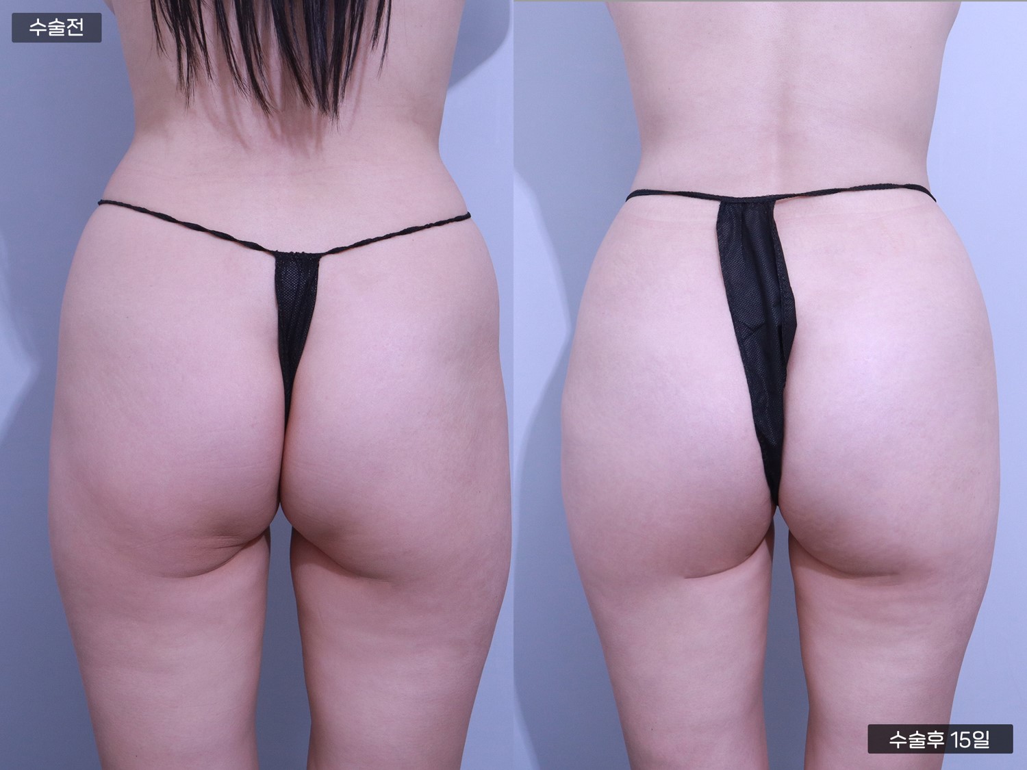 PRP 엉덩이 지방이식 (275cc + 275cc)