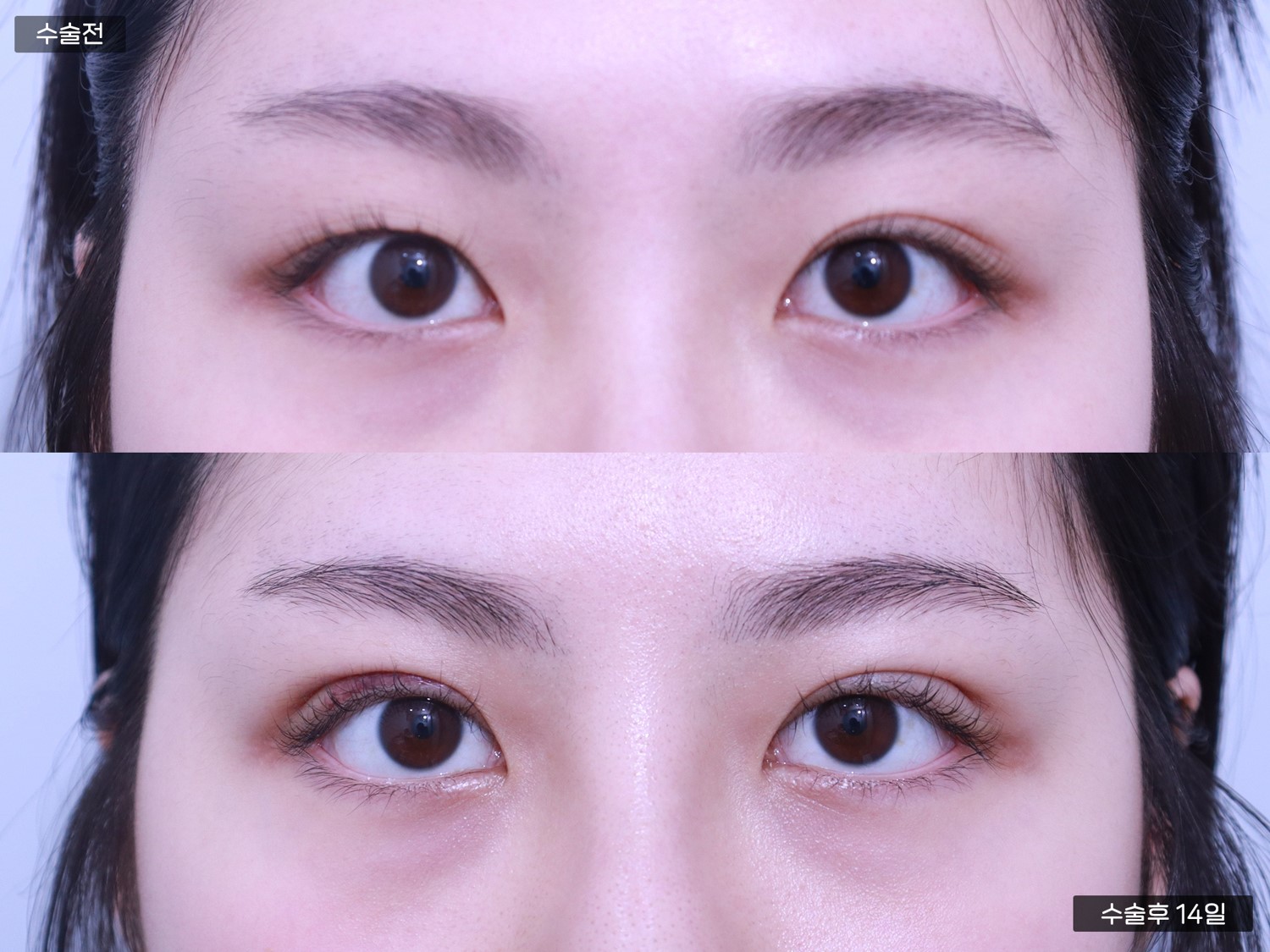 자연유착 쌍꺼풀