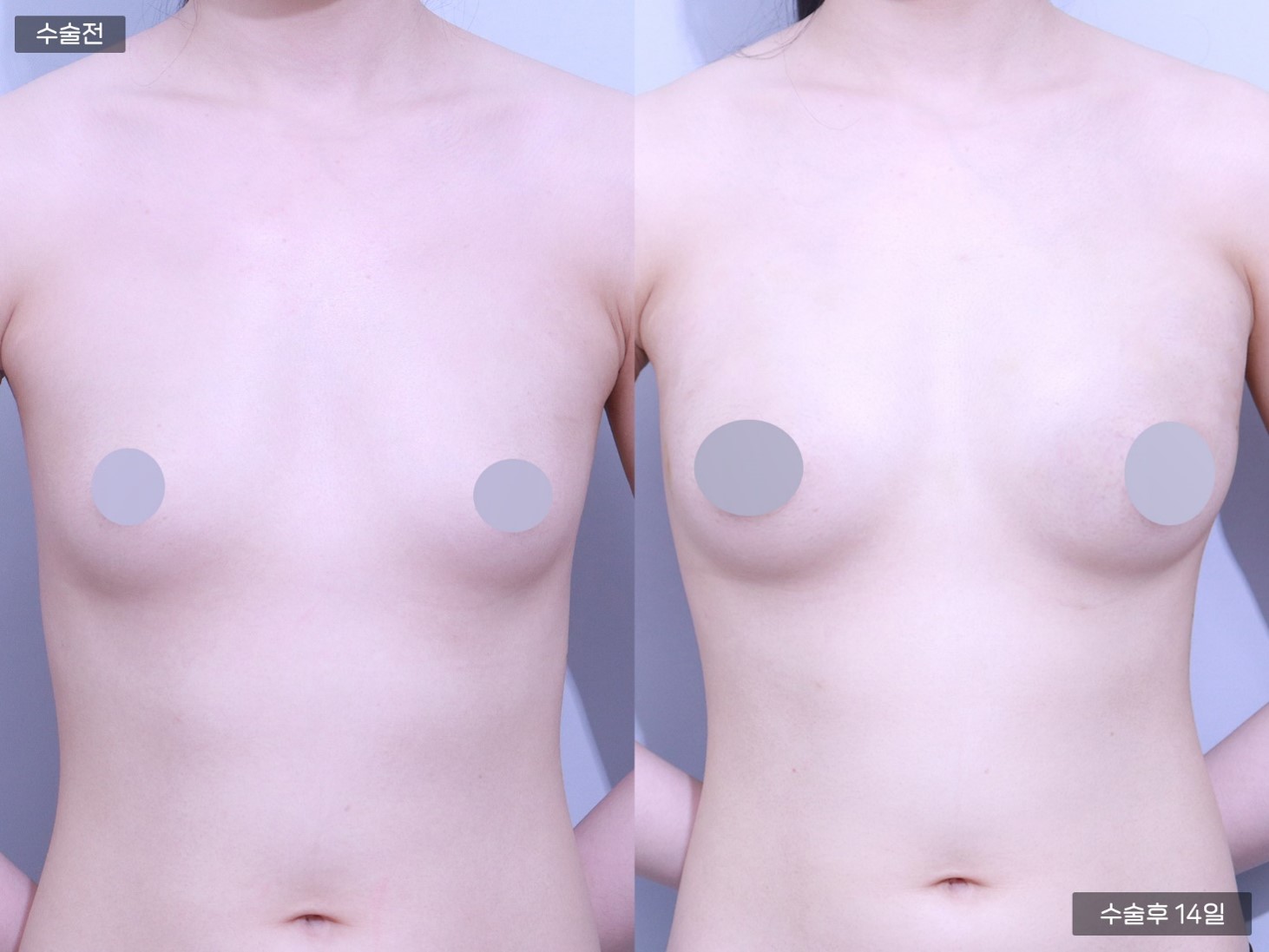줄기세포 가슴지방이식 (200cc + 200cc)