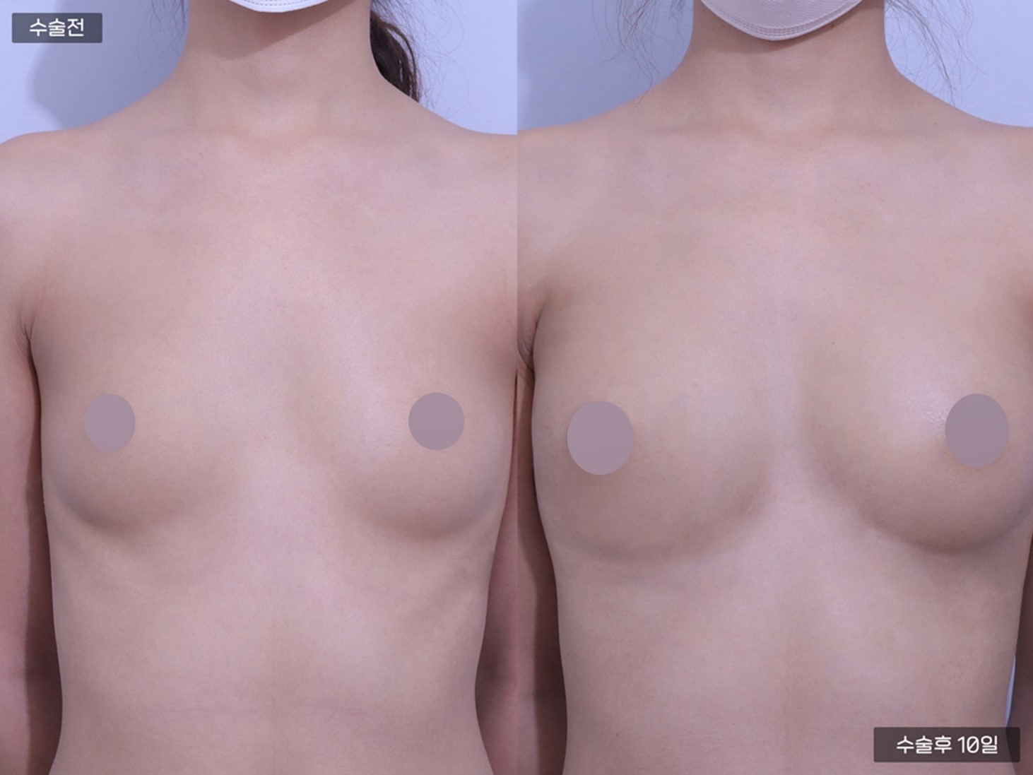 PRP 가슴지방이식 (250cc + 250cc)
