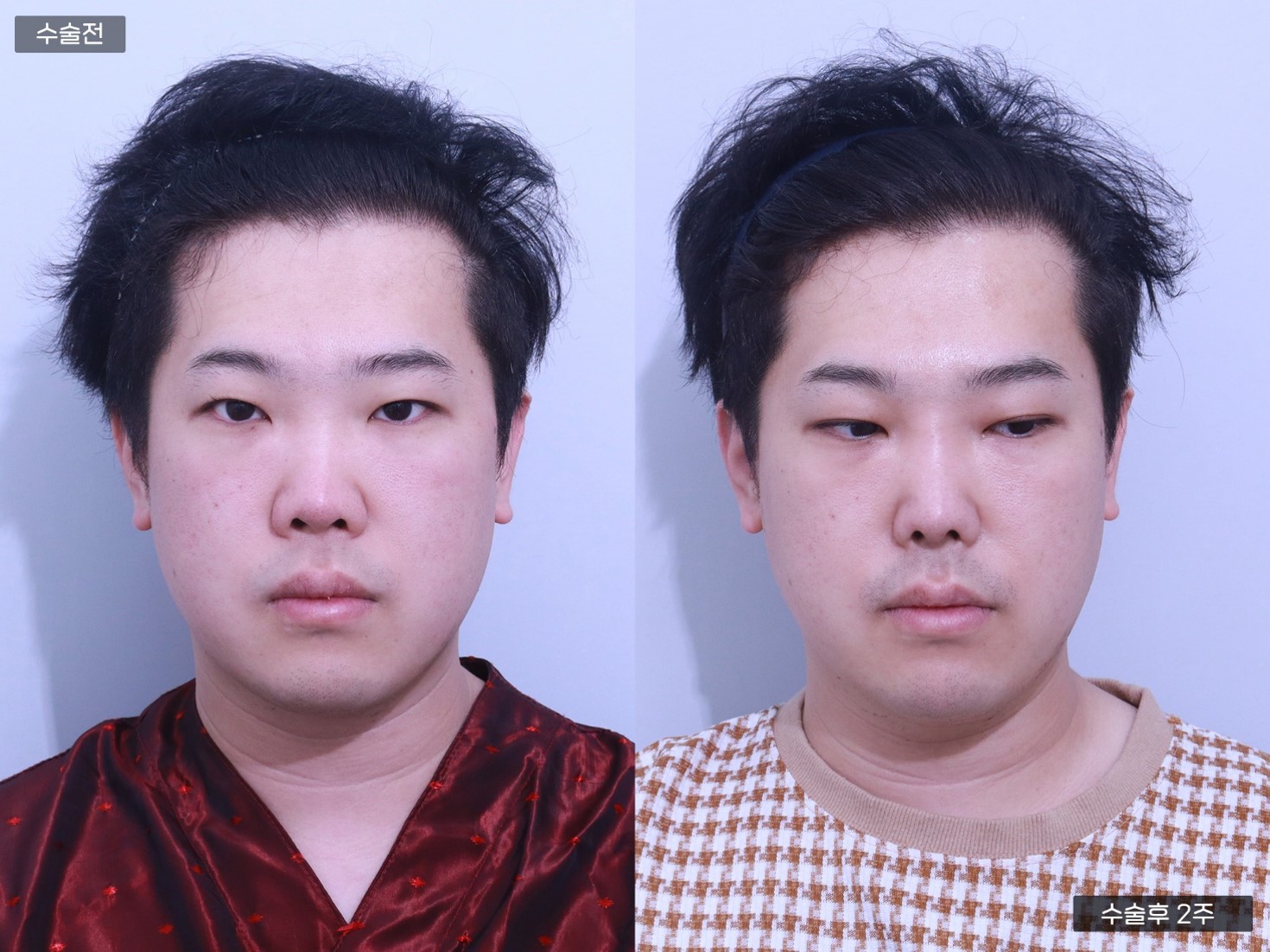 콧대교정 + 콧볼축소술