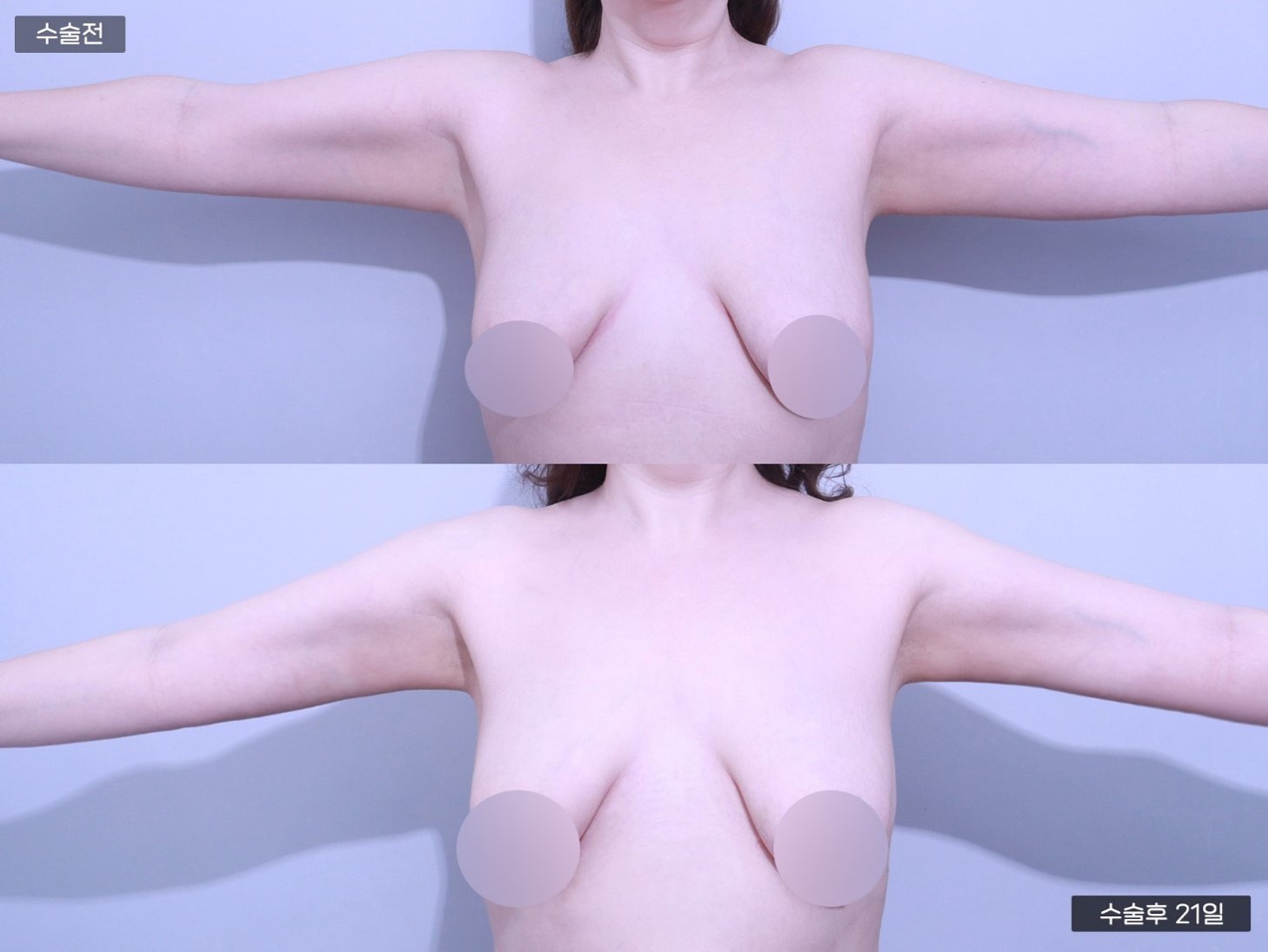 바디 지방흡입 [팔]