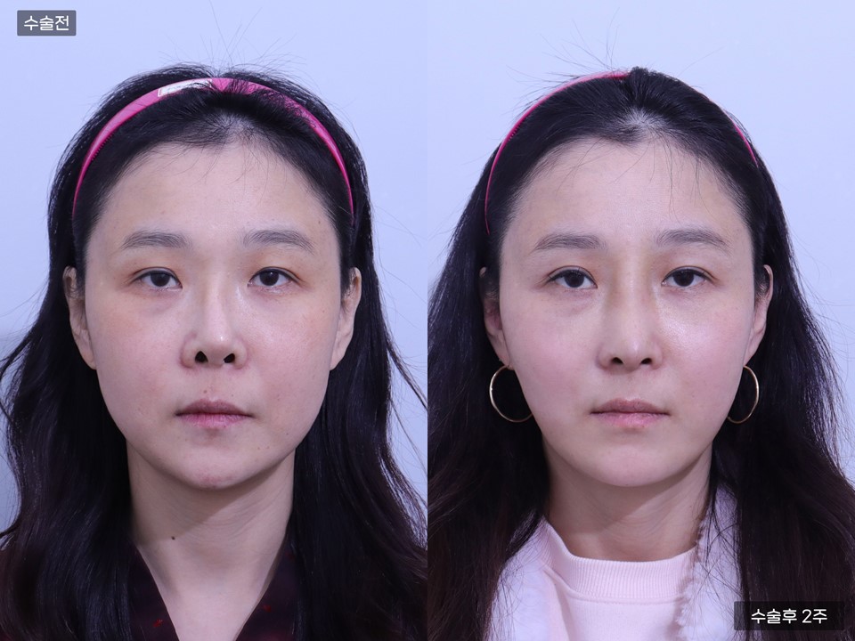 코재수술 + 휜코교정 + 코끝교정 + 짧은코 + 콧볼축소 + 비공내리기