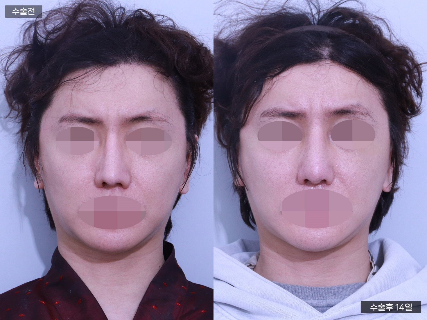 코재수술 + 남자코 + 콧대