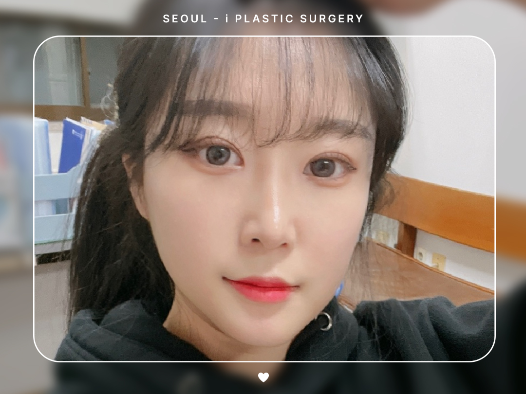 #자연유착 #눈매교정 #앞뒤밑트임