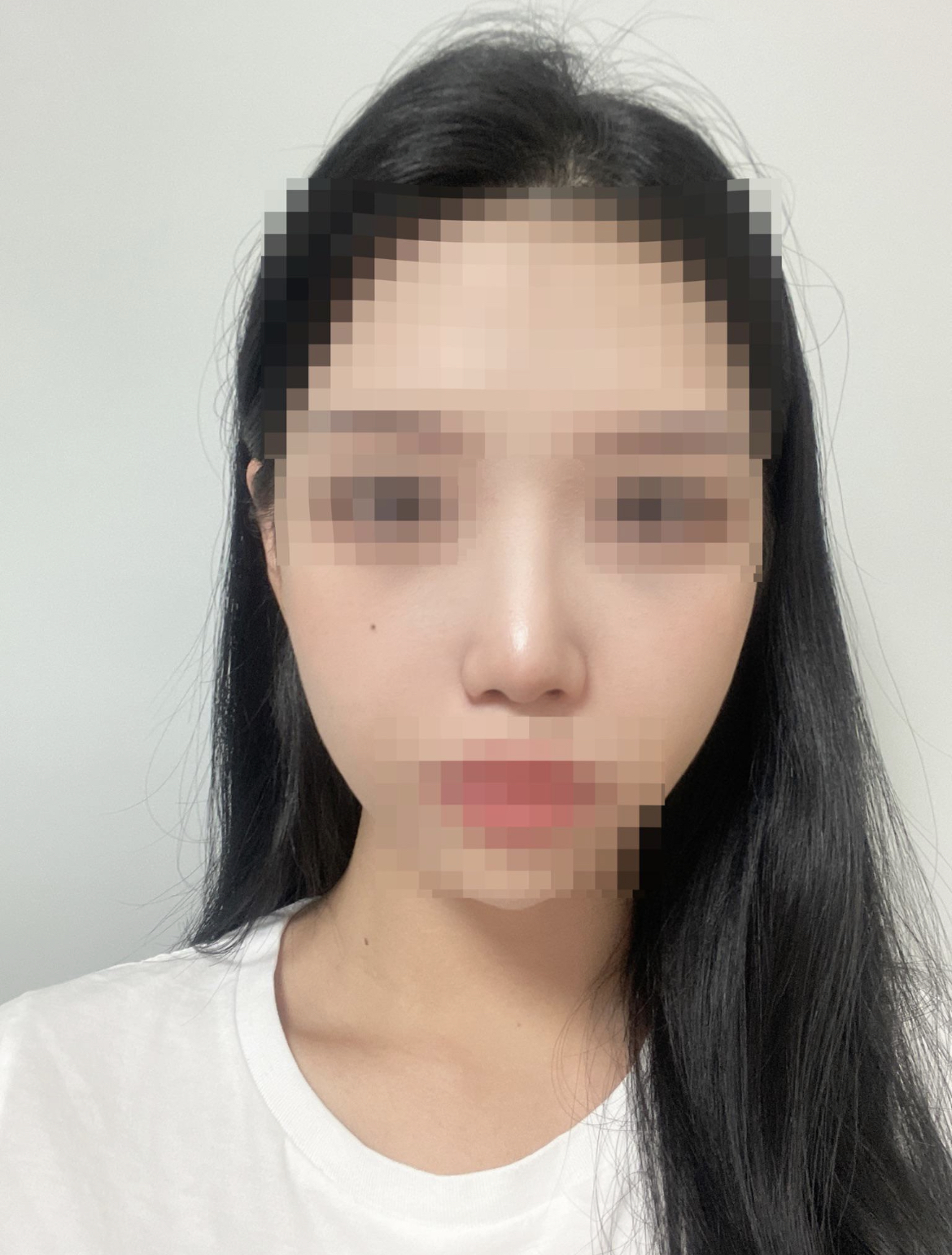 수술후기이미지