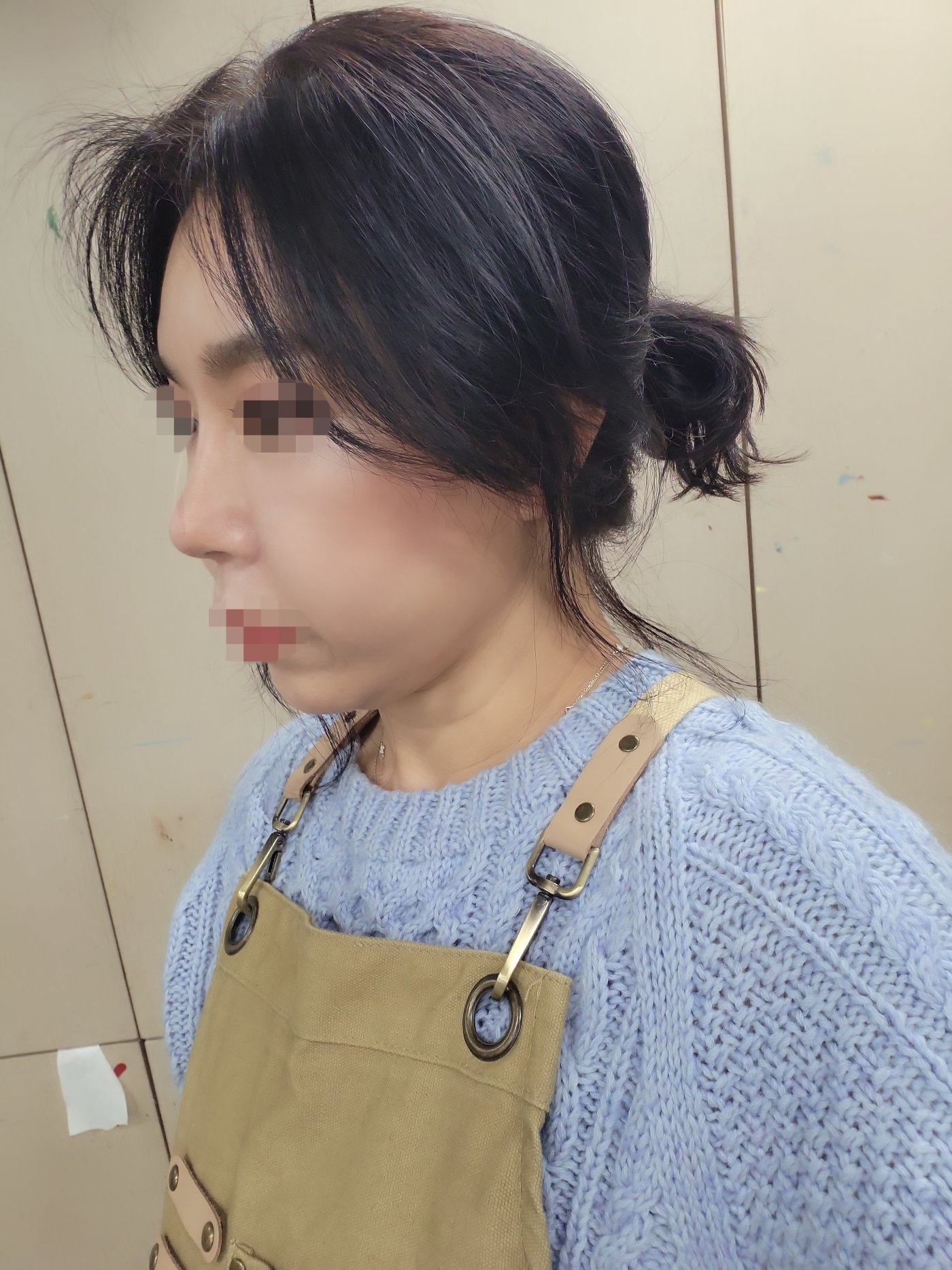 수술후기이미지