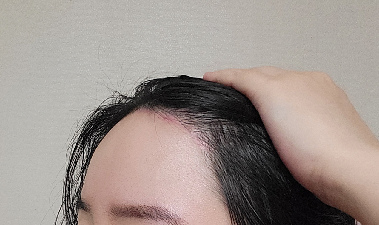 수술후기이미지