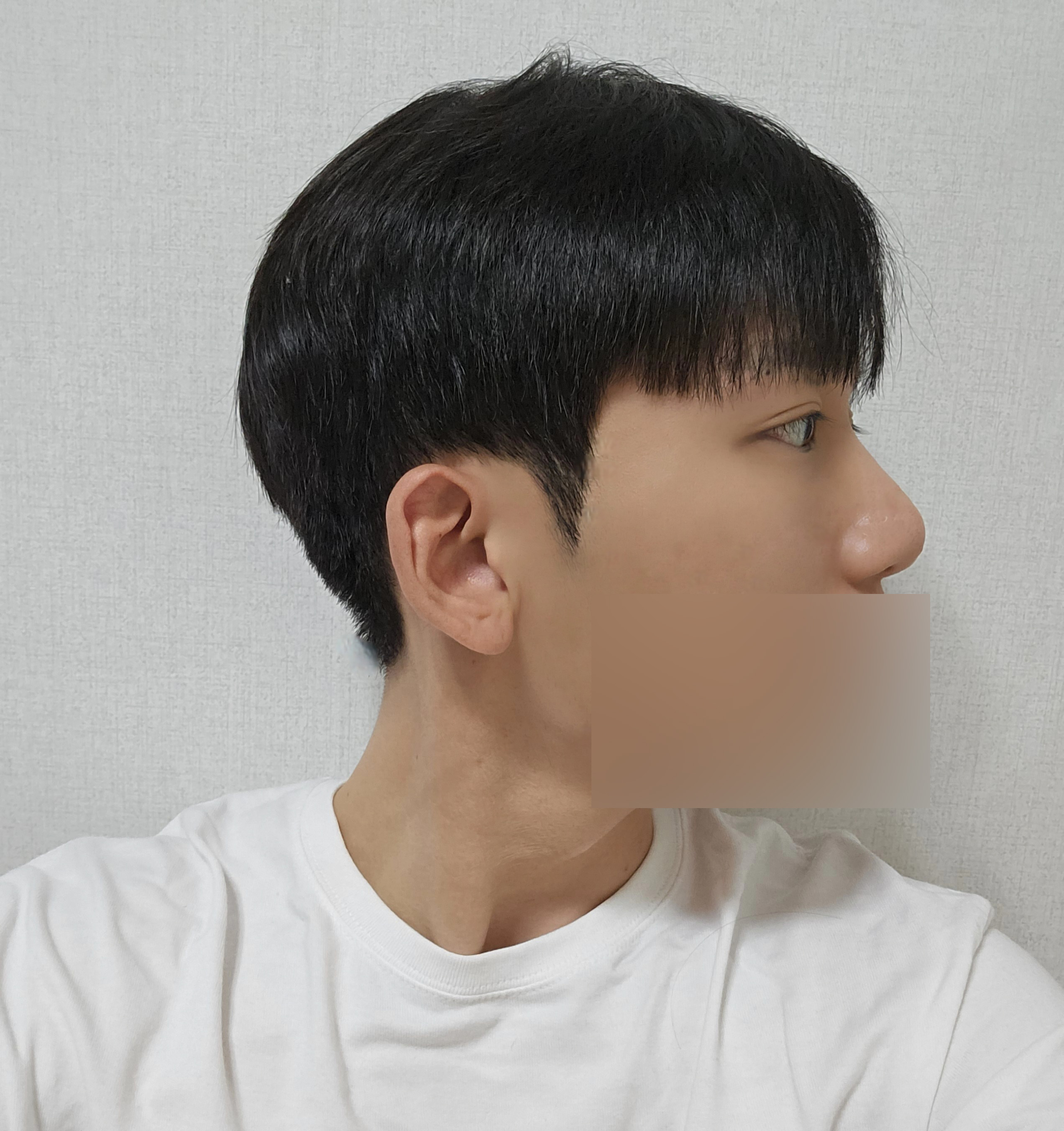 수술후기이미지