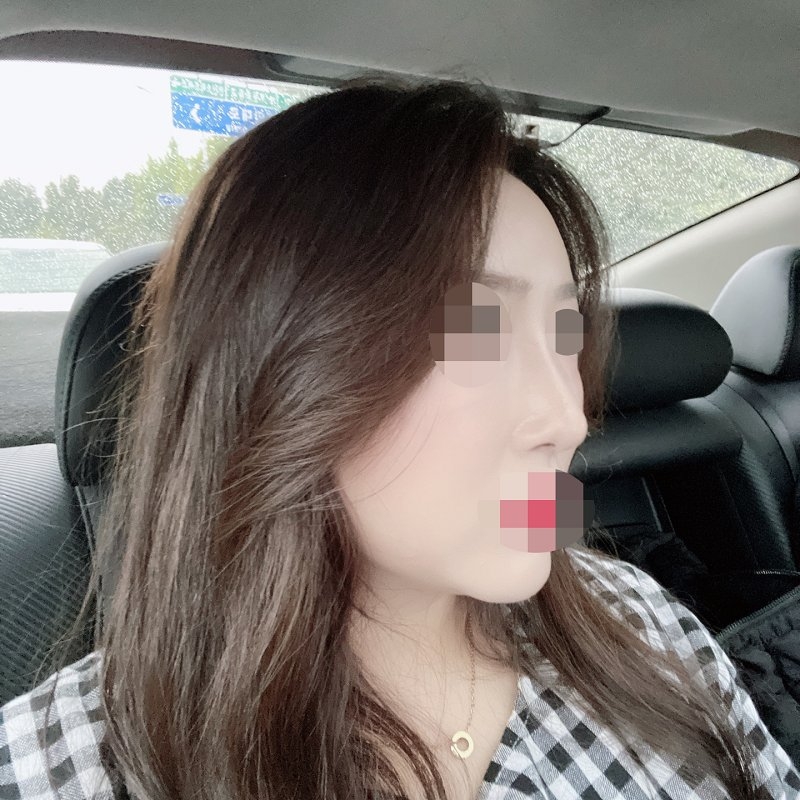 수술후기이미지