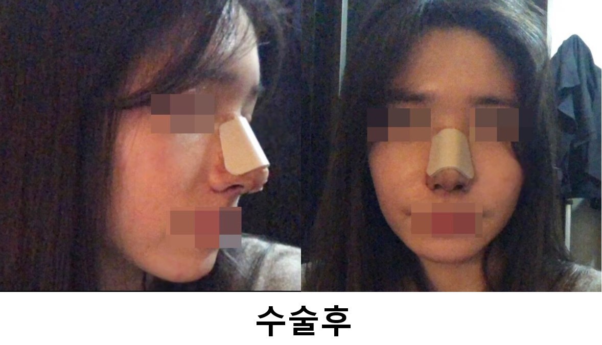 수술후기이미지