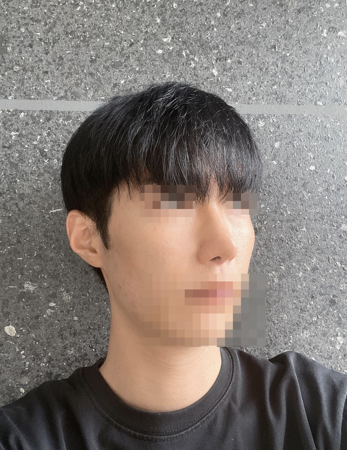 수술후기이미지