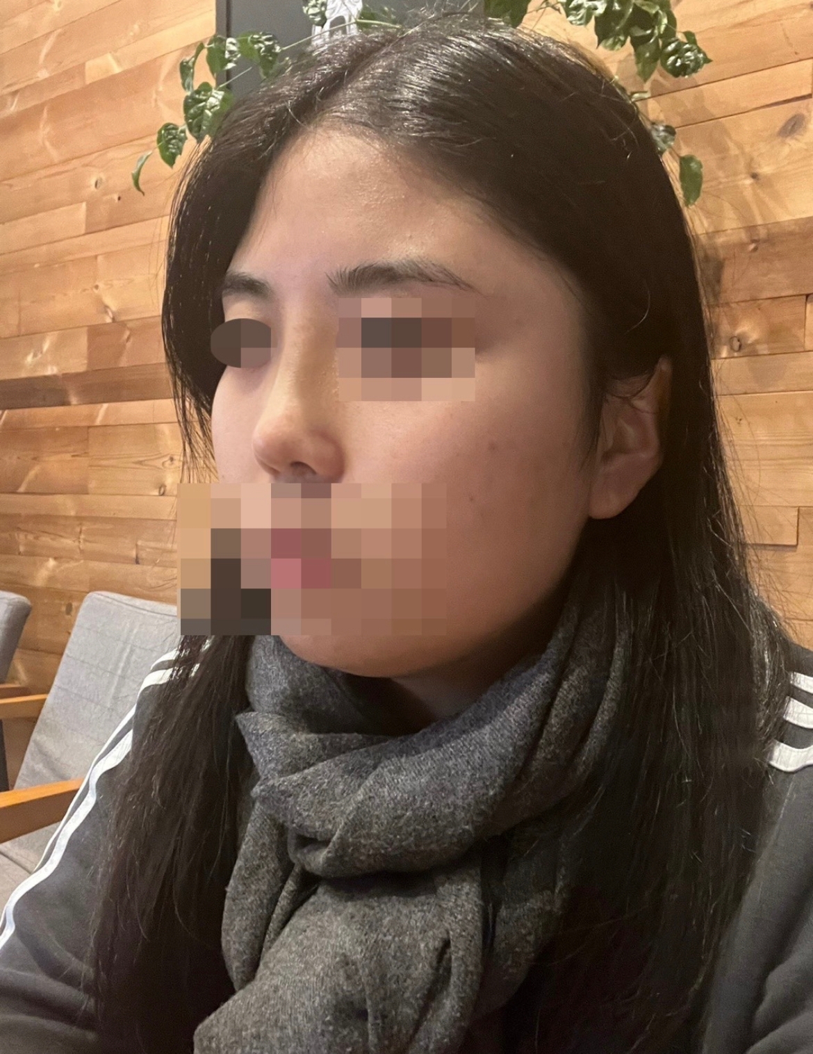 수술후기이미지