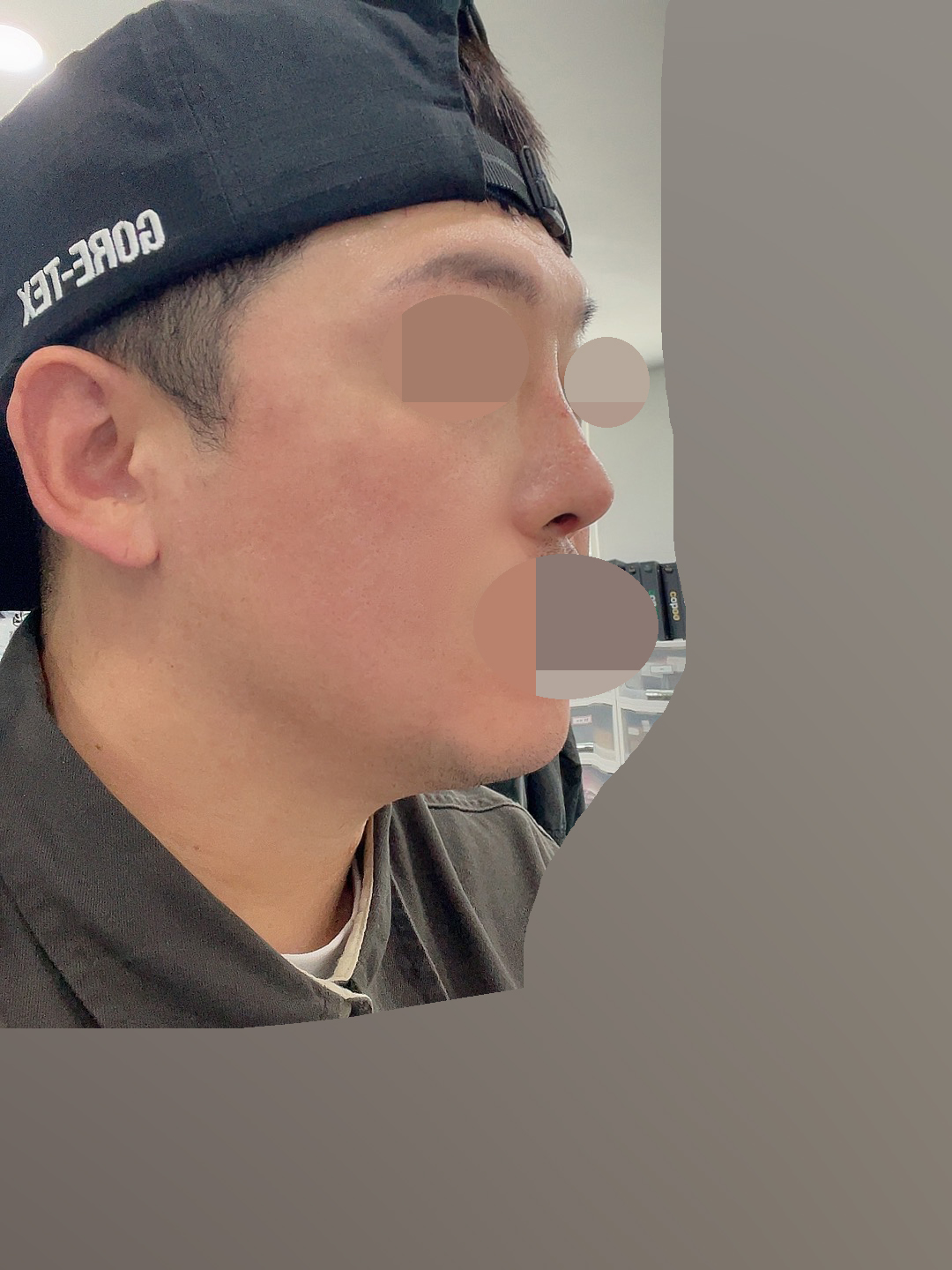 수술후기이미지