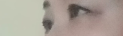 수술후기이미지