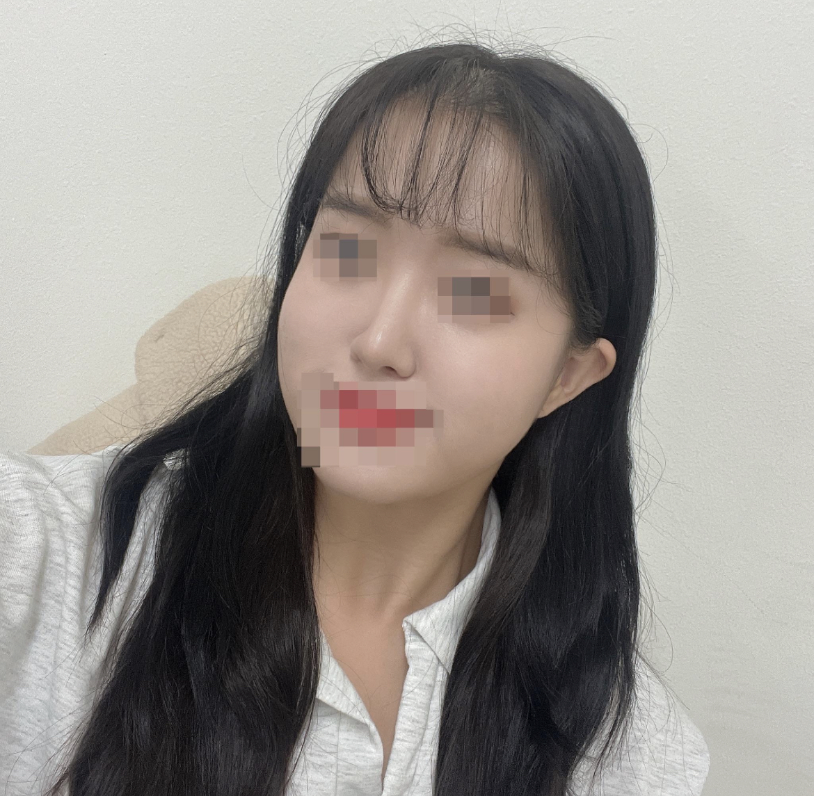 수술후기이미지