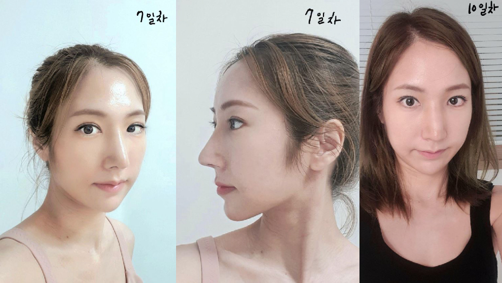 수술후기이미지