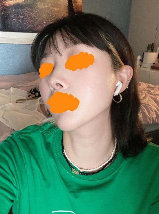 수술후기이미지