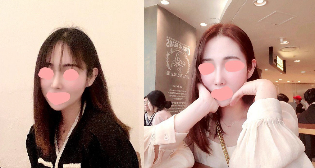 수술후기이미지