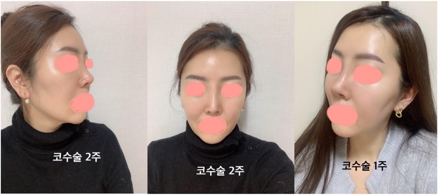 수술후기이미지