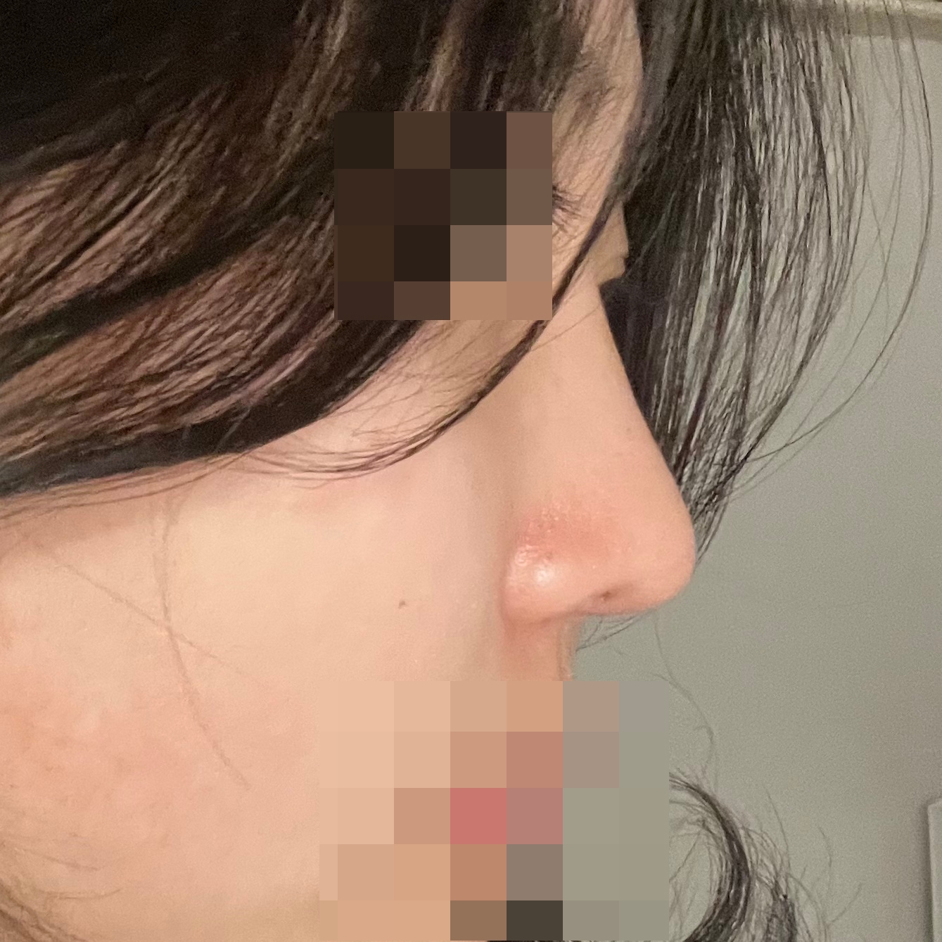 수술후기이미지