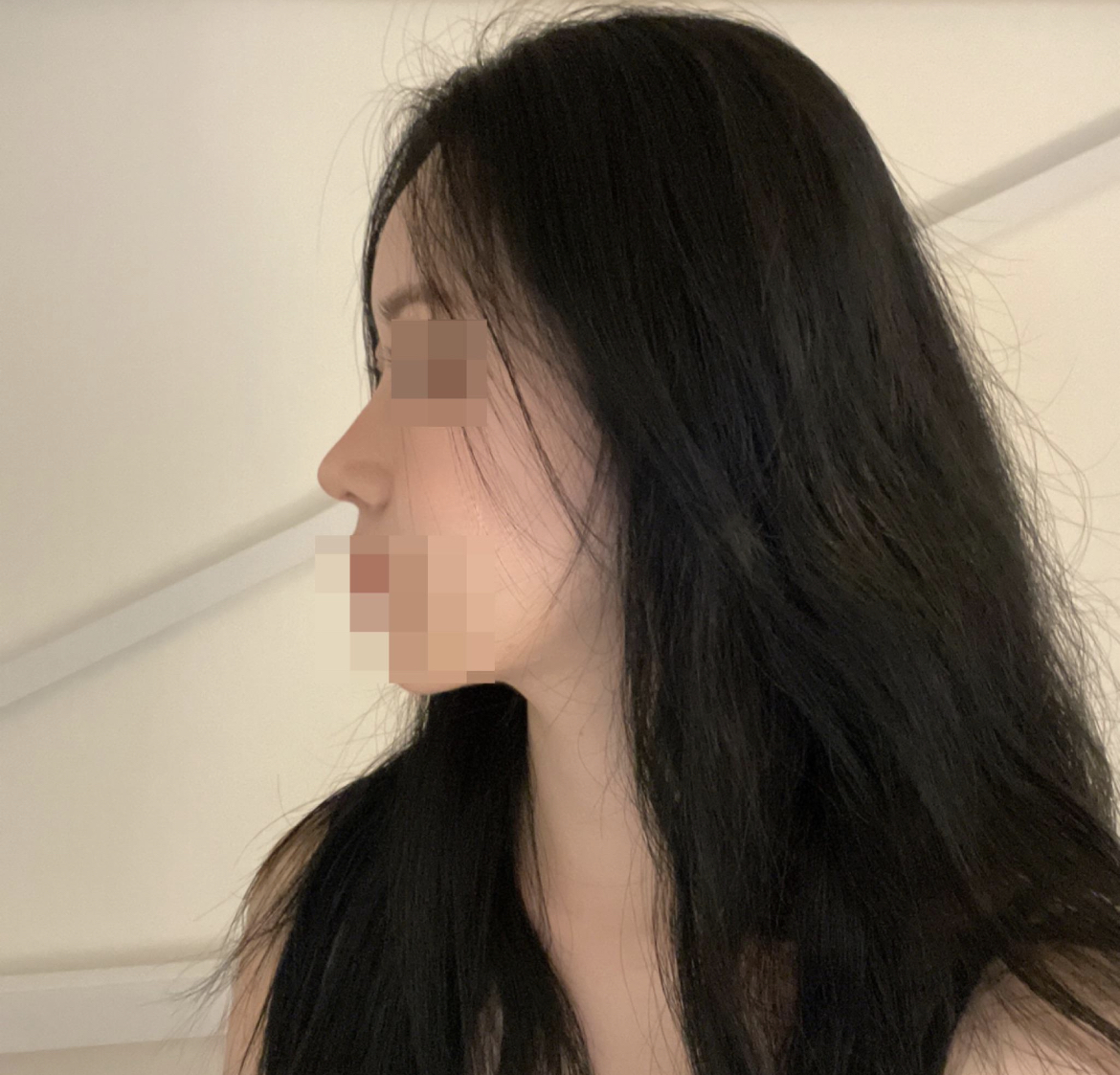 수술후기이미지