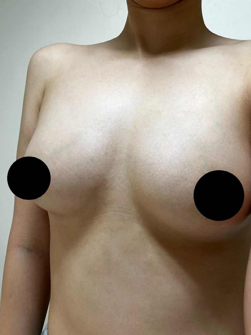 수술후기이미지