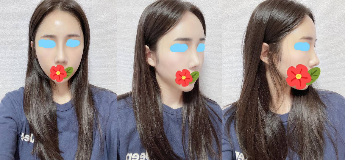 수술후기이미지