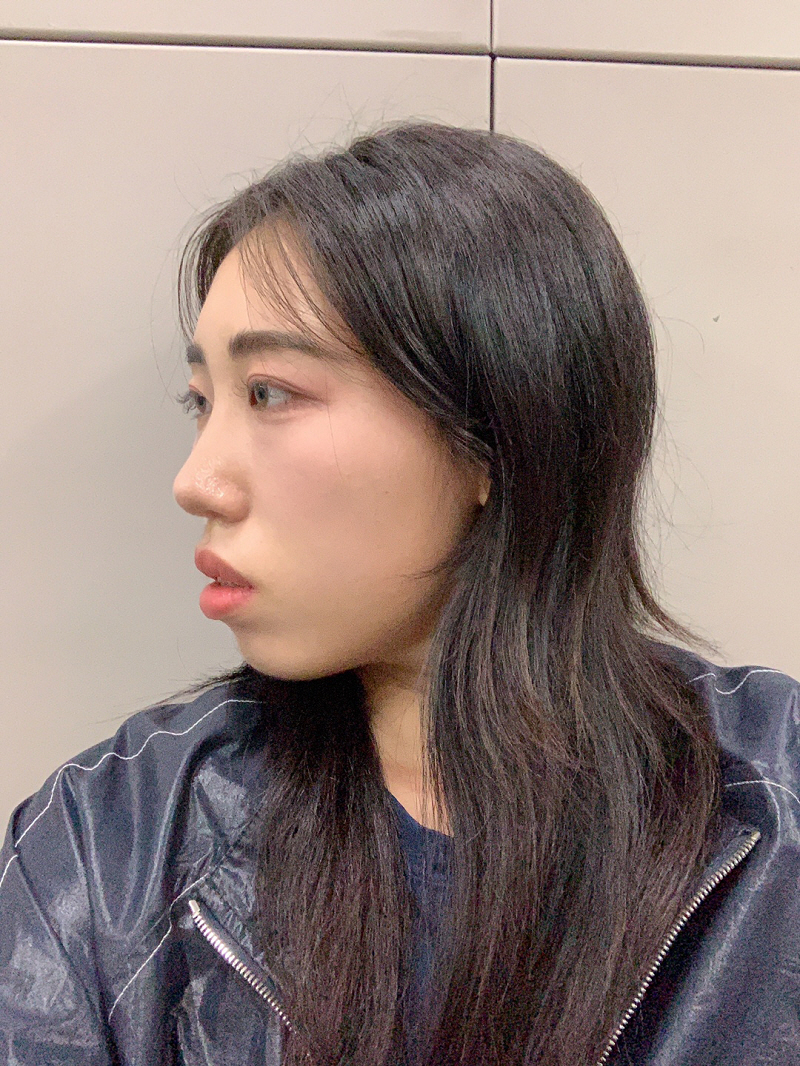 수술후기이미지