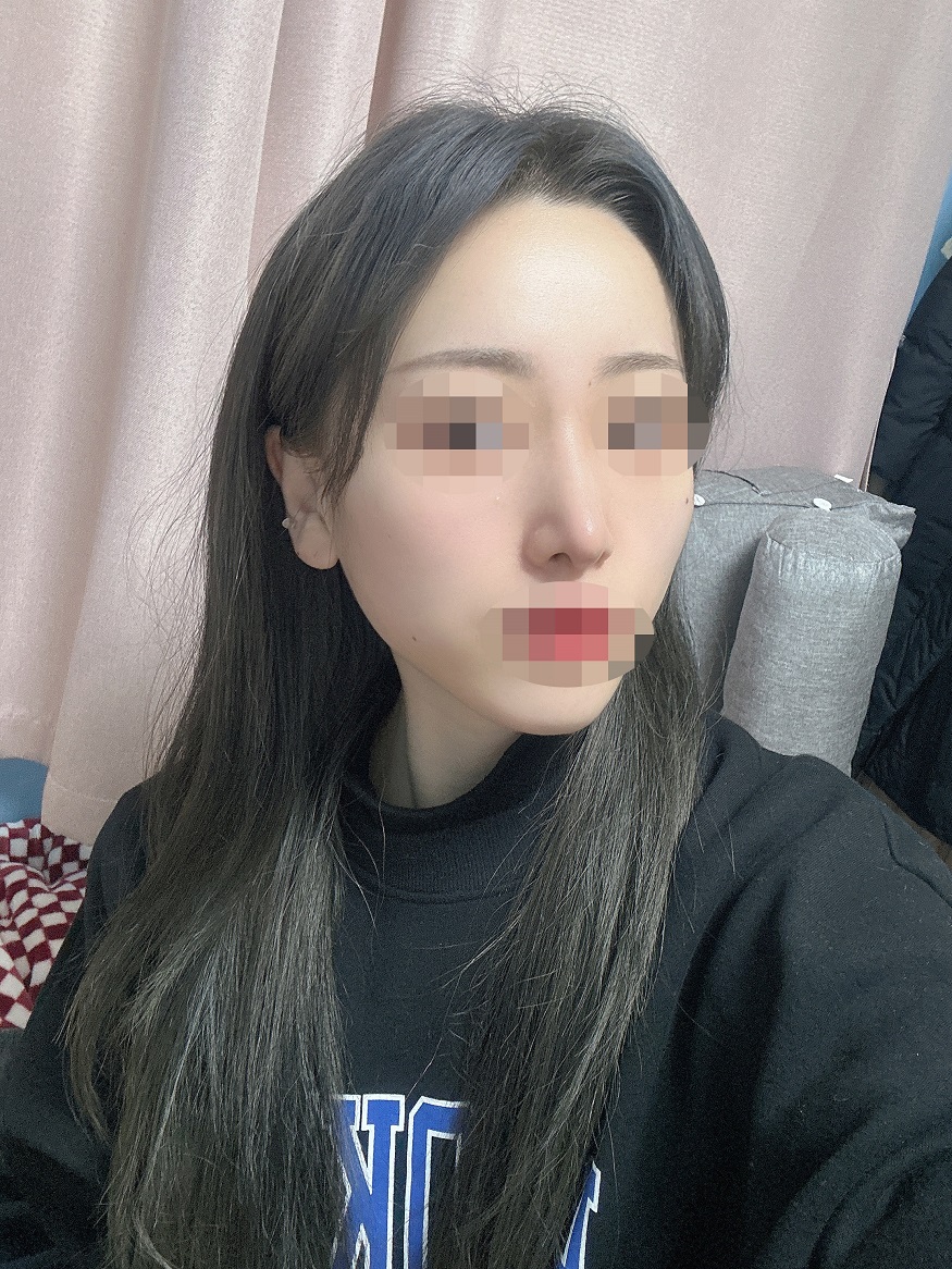 수술후기이미지