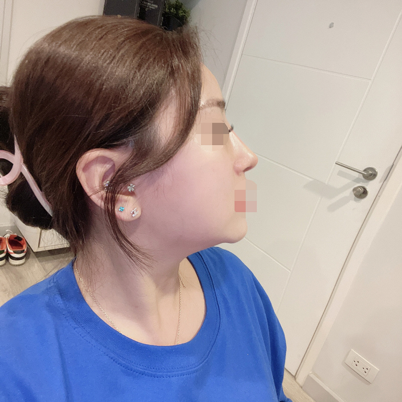 수술후기이미지