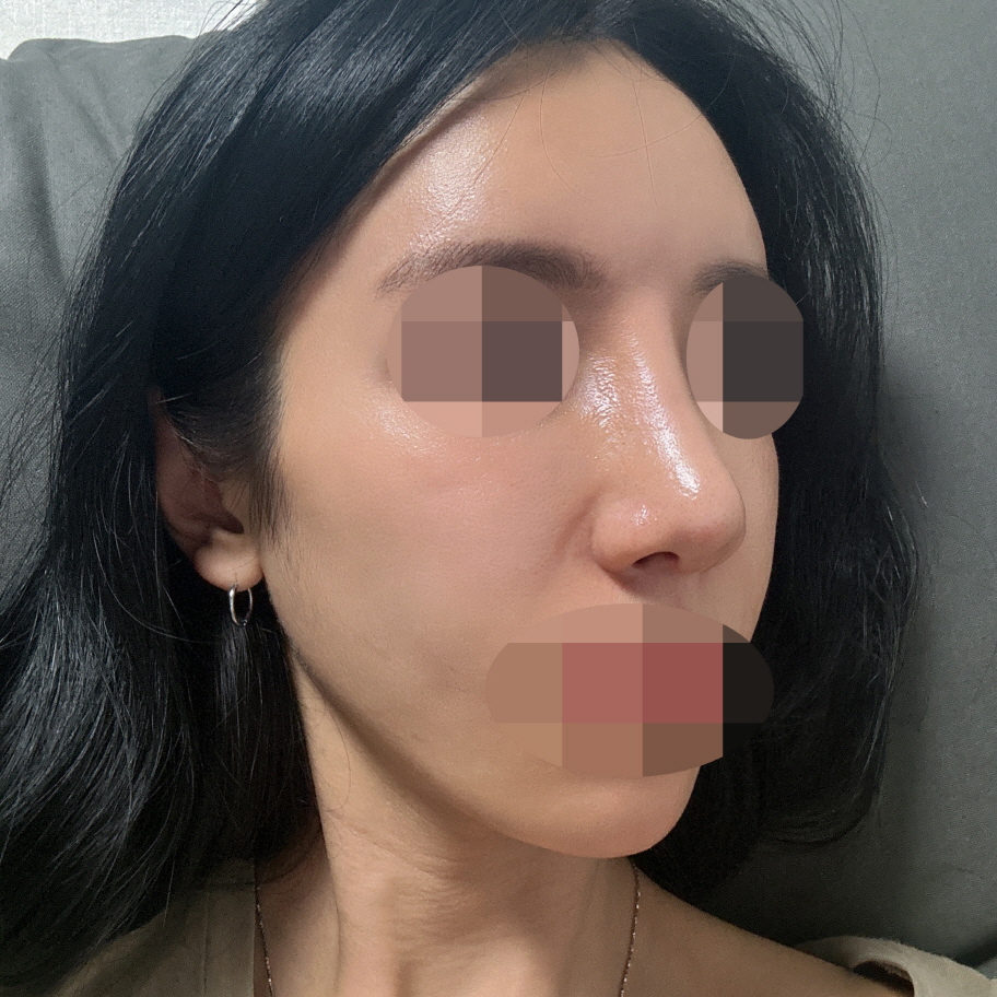 수술후기이미지