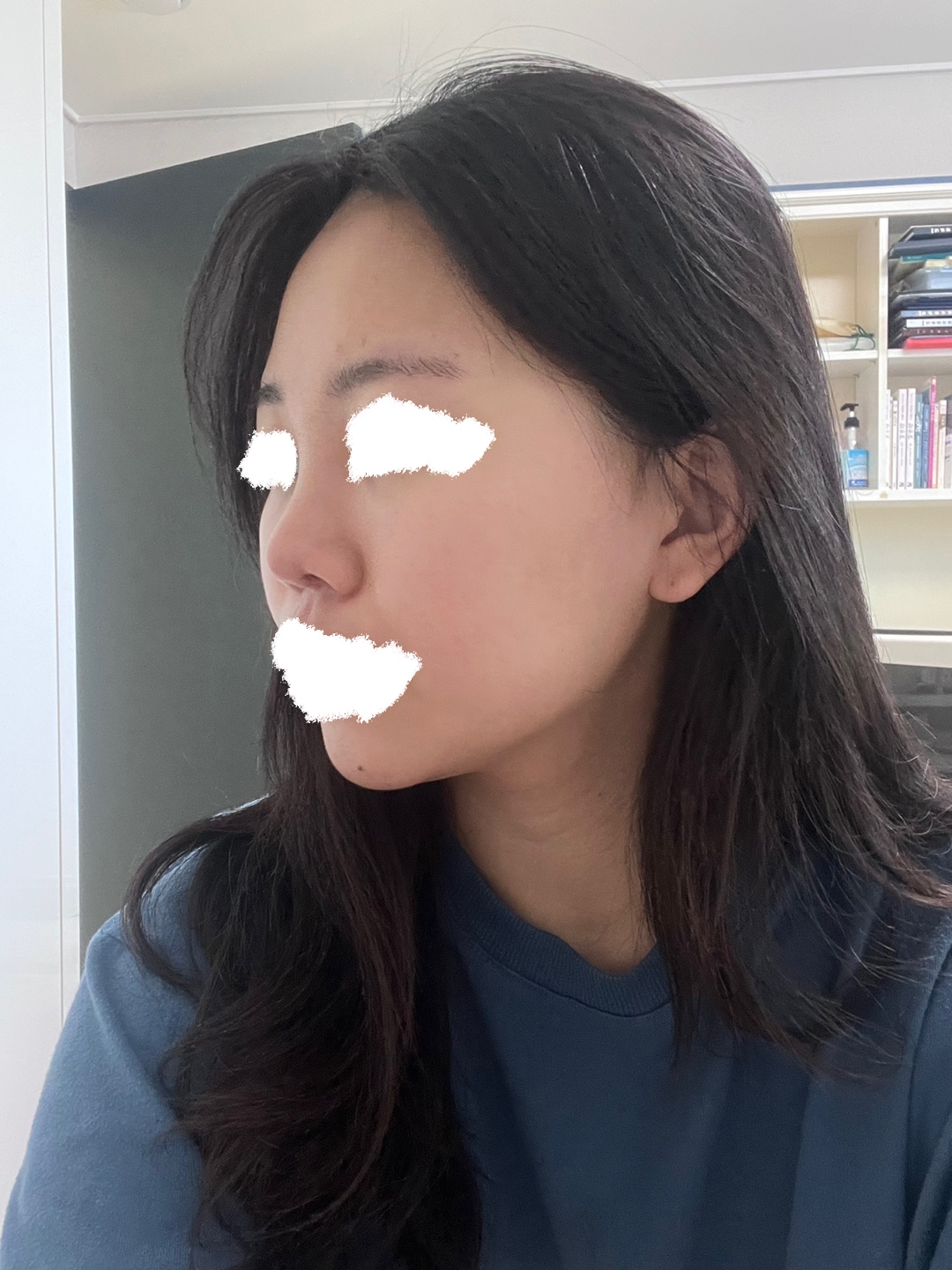 수술후기이미지