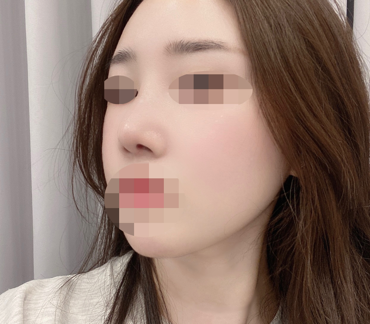 수술후기이미지