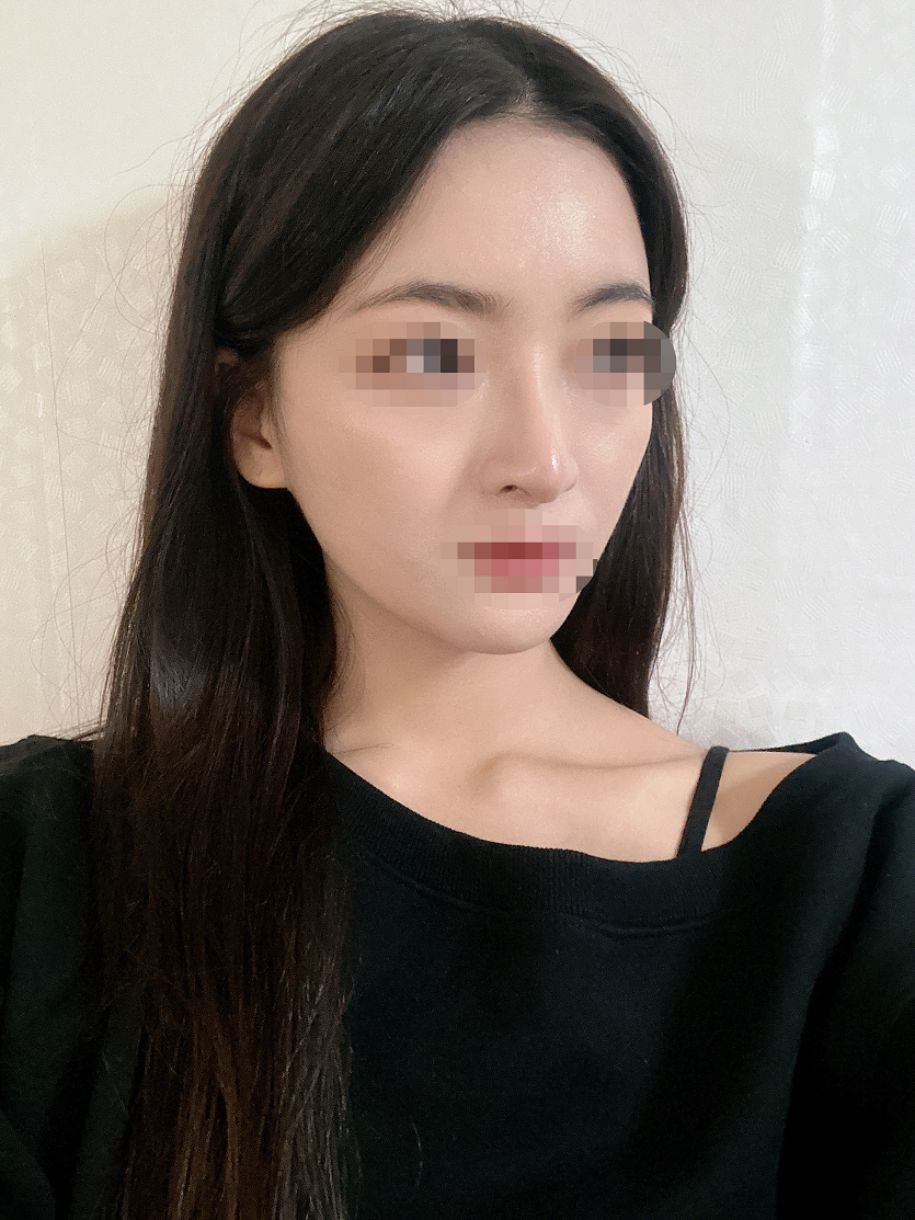 수술후기이미지