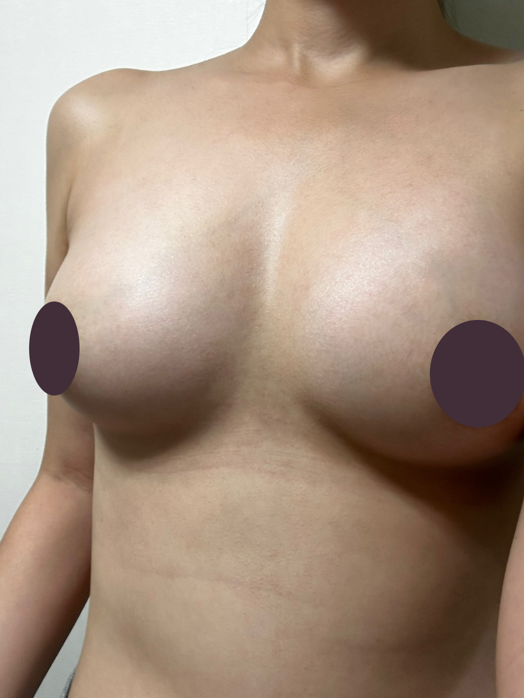 수술후기이미지