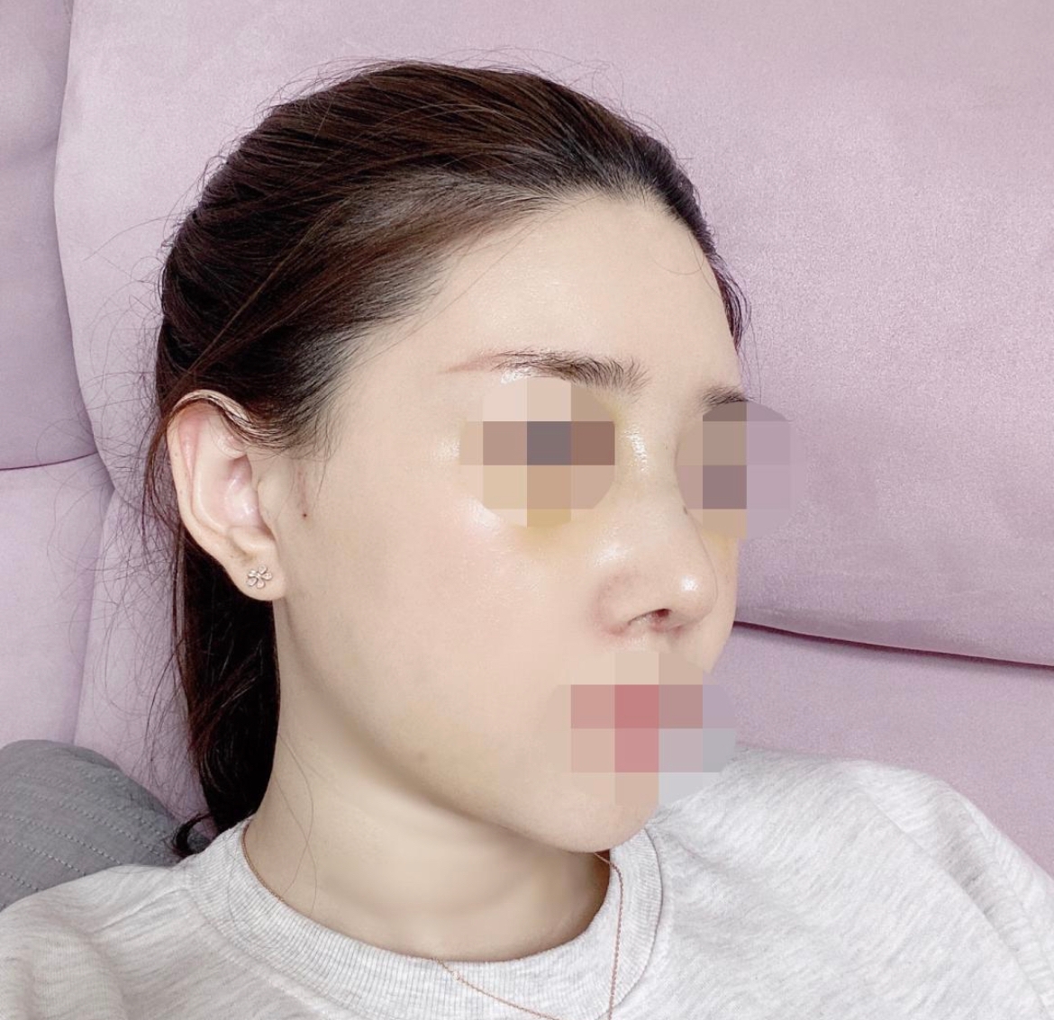 수술후기이미지