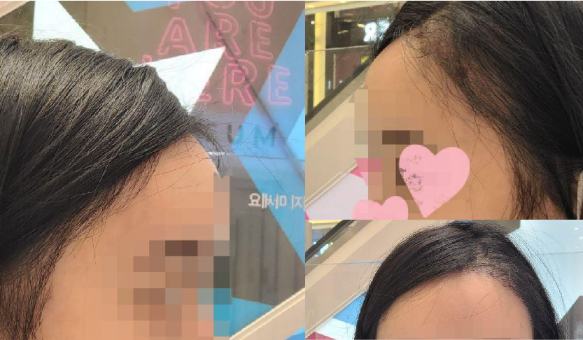 모발이식했습니다