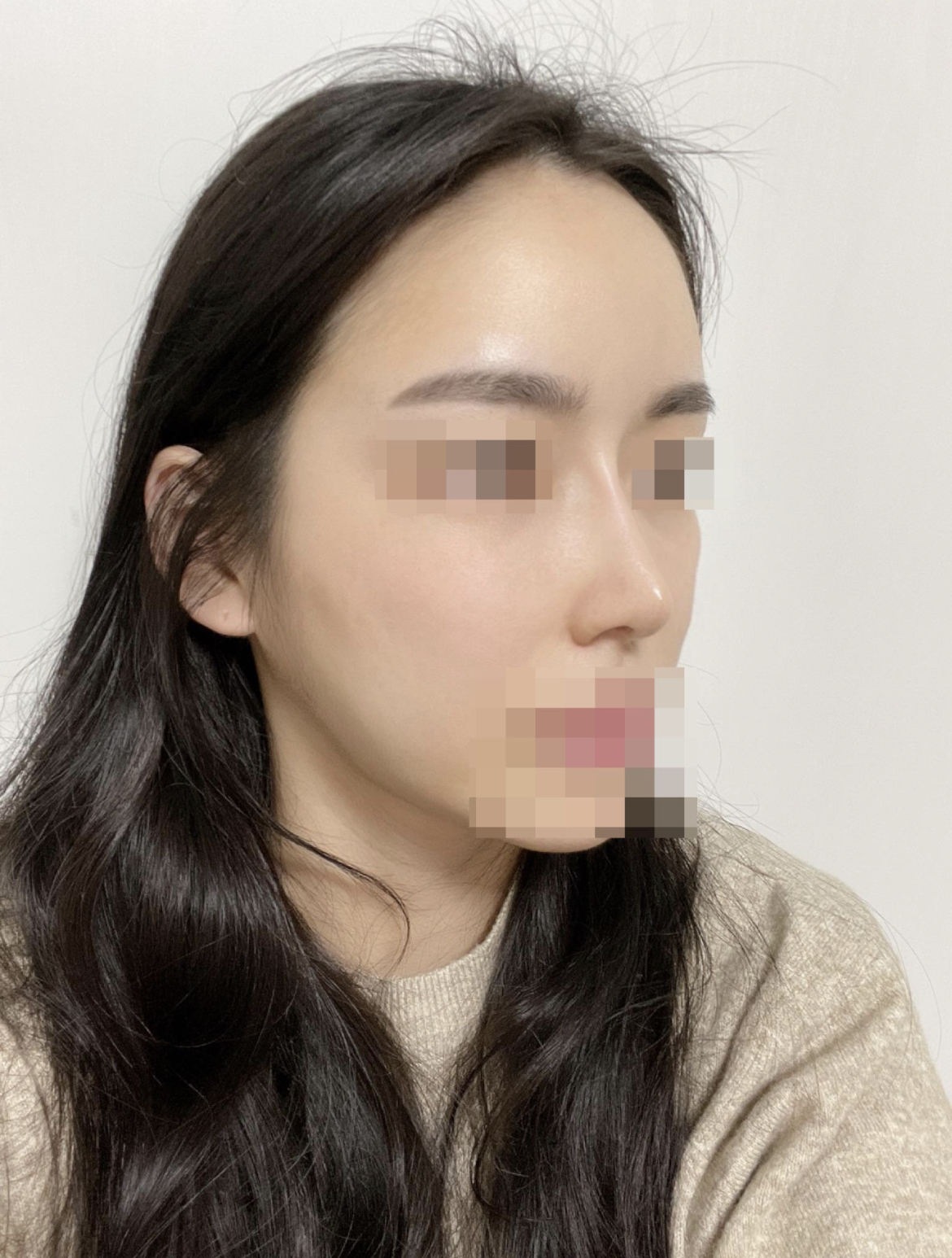 수술후기이미지