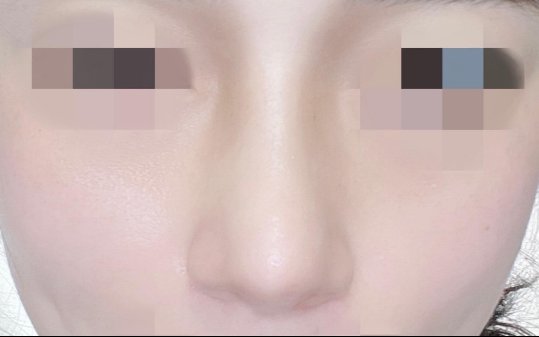 수술후기이미지