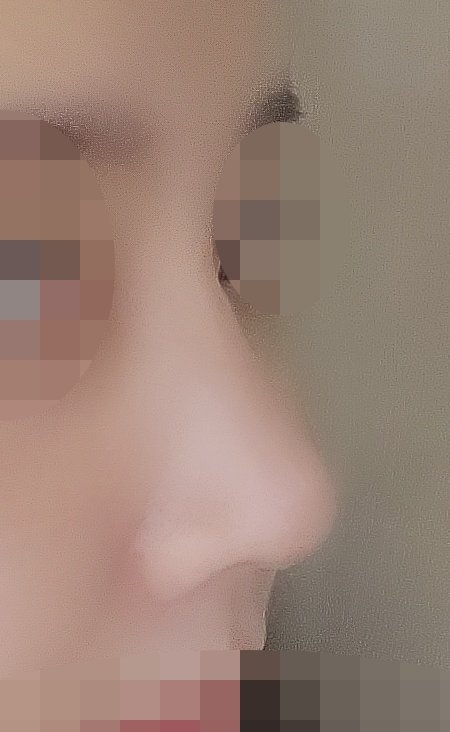 수술후기이미지