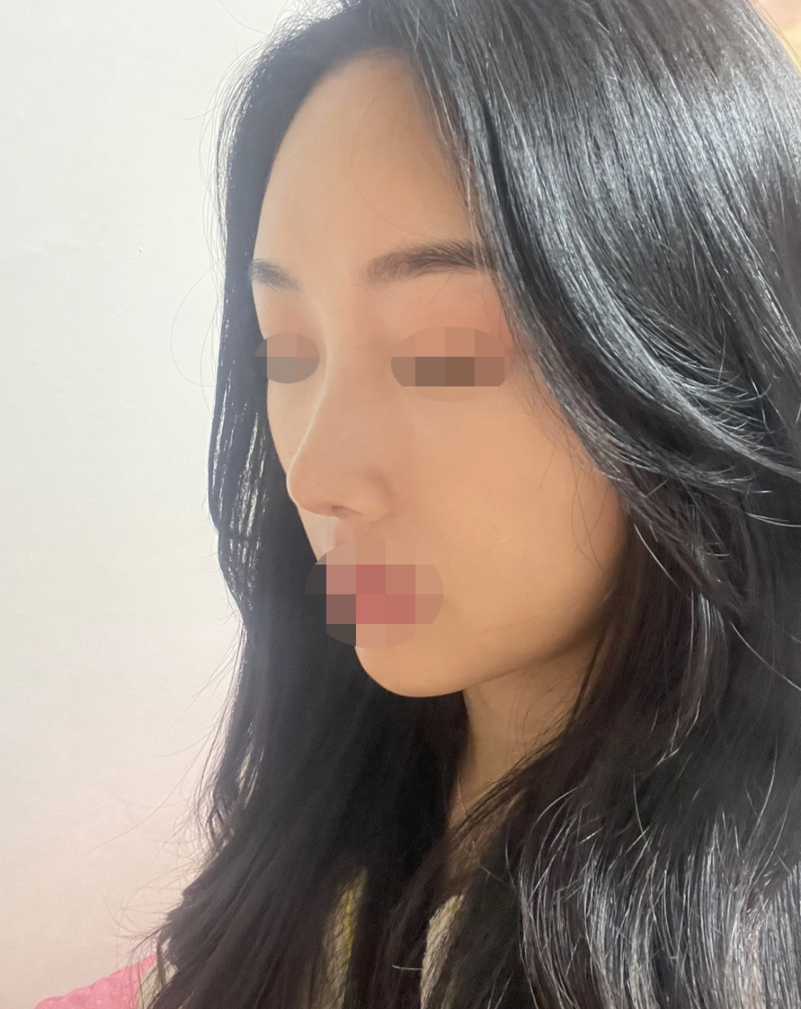 수술후기이미지