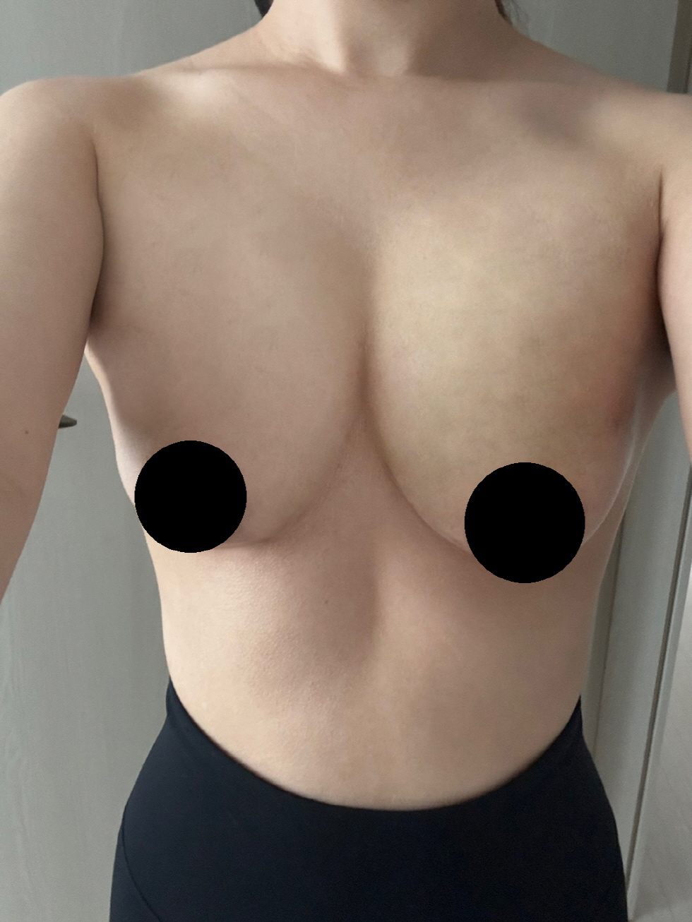 수술후기이미지