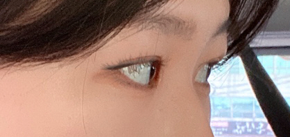 수술후기이미지