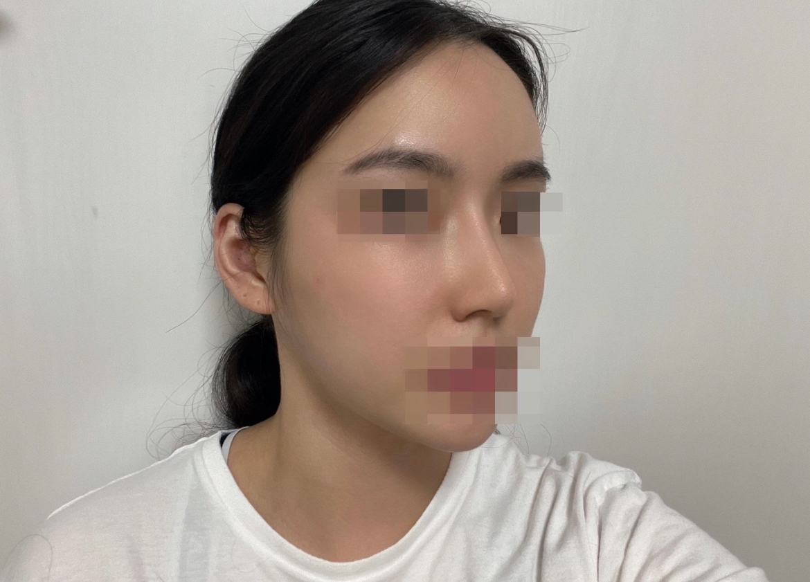 수술후기이미지